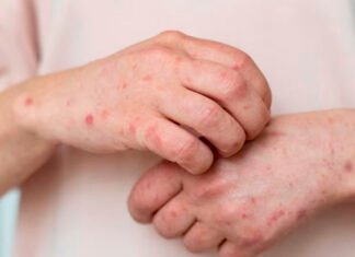 Se registraron más de 50 mil casos de sífilis