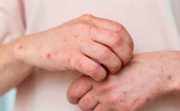 Se registraron más de 50 mil casos de sífilis